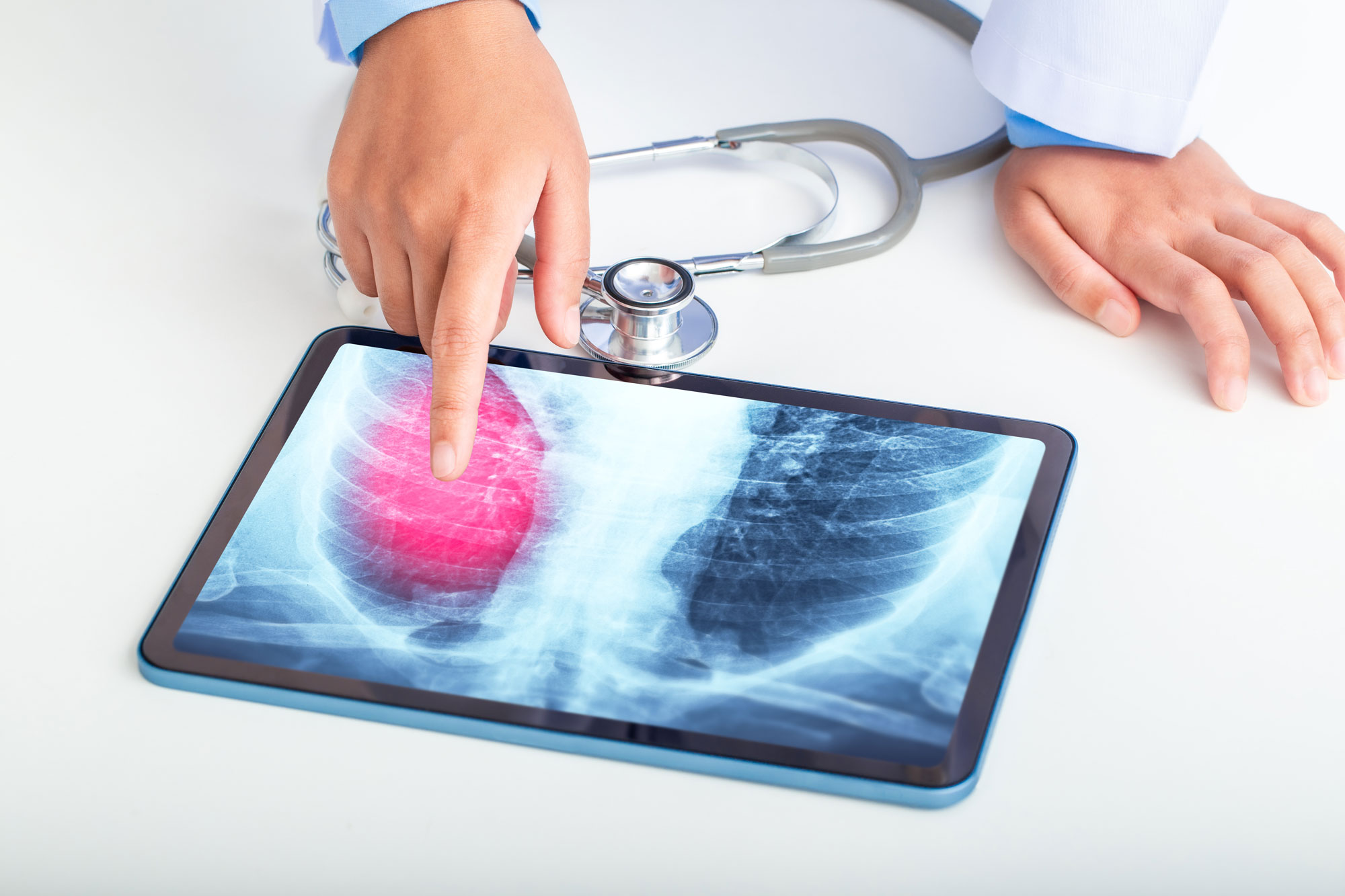 Arzt oder Wissenschaftler zeigt dem Patienten auf dem Tablet-Bildschirm die Ergebnisse der Lungenuntersuchung durch Röntgenaufnahmen der Brust. Lungenkrebs, Lungenentzündung, Lungeninfektion. Bildquelle: Kt Stock.soch.adobe.com
