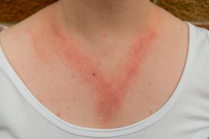 Dame mit allergischem Kontaktekzem, roter Ausschlag auf Brust und Hals als Reaktion auf eine Nickelschmuck-Halskette. Bildquelle: HASPhotos-stock.adobe.com
